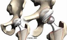 Phòng tránh trật khớp háng sau mổ thay khớp háng